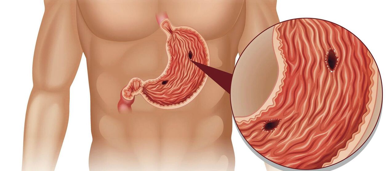 Bauch ulcer